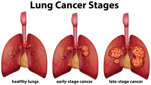Lung Cancer service image