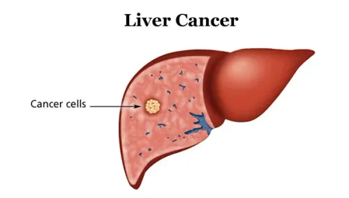  Liver Cancer service image