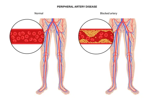 Peripheral Artery Disease Treatment in Pune service image
