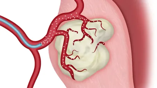 ⁠Uterine Fibroid Embolization Treatment in Pune service image