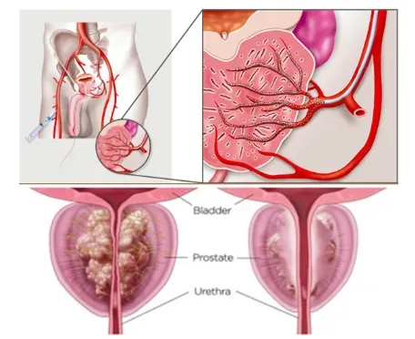 Prostate Artery Embolization Treatment in Pune service image