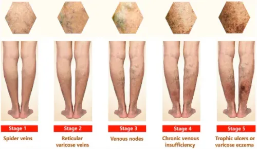 Varicose Veins- VenaSeal and Laser Treatment in Pune service image
