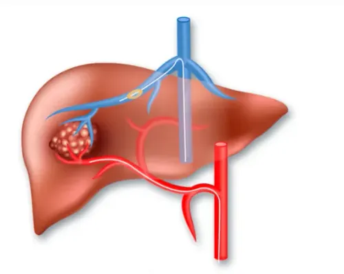 ⁠Liver Cancer Chemo Embolization and Ablation Treatment in Pune service image