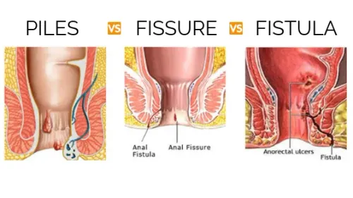 PILES,FISTULA & FISSURES service image