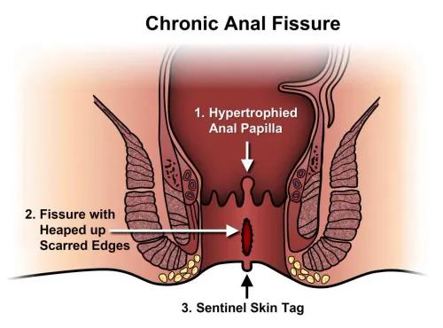 Treatment for Fissure service image