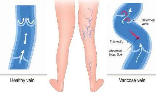 Varicose Veins Specialist in Baner, Aundh, Pune service image
