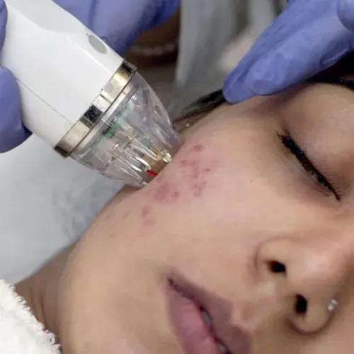 MNRF Treatment for Scars in Thane service image