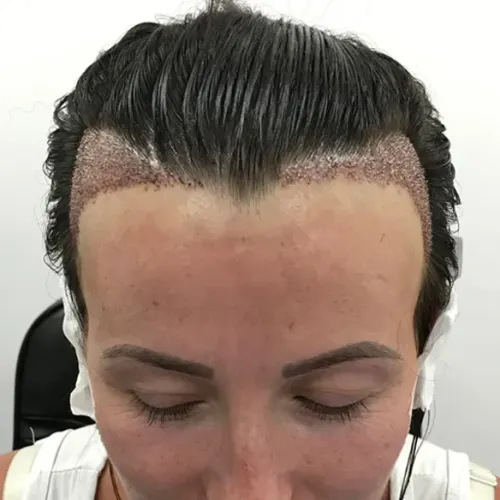Female Hair Transplant in Thane service image