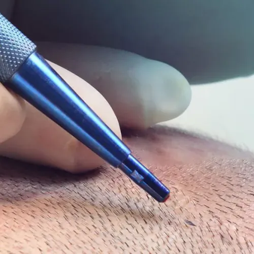 Sapphire Hair Transplant service image
