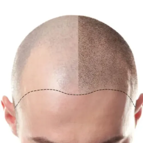 SMP (Scalp Micro Pigmentation) Treatment in Thane service image