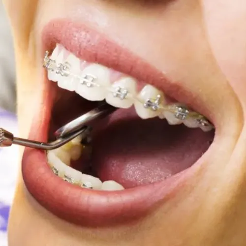 Braces Treatment in Thane service image