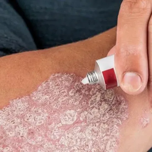 Psoriasis Treatment in Thane service image