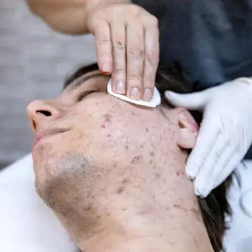 Acne Treatment in Thane service image