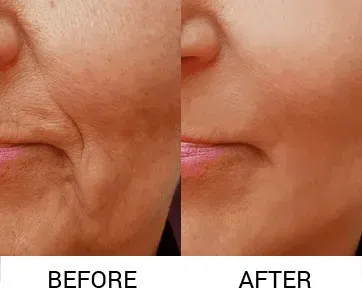 Hifu Treatment  Treatment service image