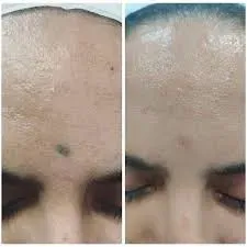 Bindi Tattoo Removal  Treatment service image