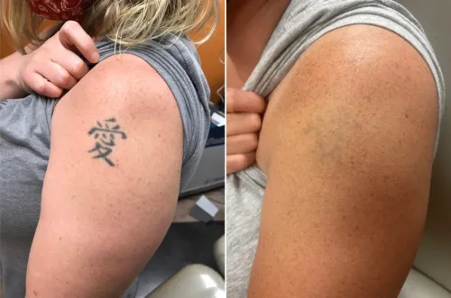 Tattoo Removal Treatment service image
