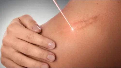 Burn Scar Removal Treatment  service image
