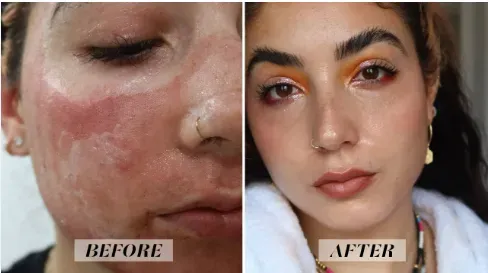 Fractional CO2 Laser Treatment service image