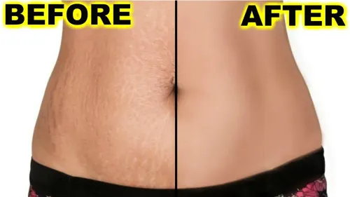 Stretch Marks Removal Treatment service image