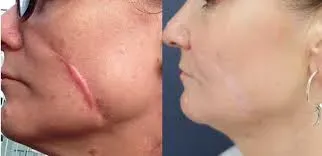 Scar Treatment service image