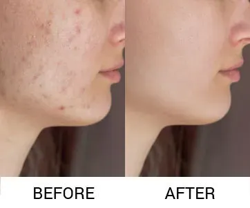 Mnrf For Acne Scar Treatment service image