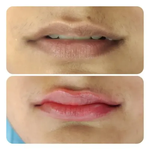 Tan Lip Removal service image
