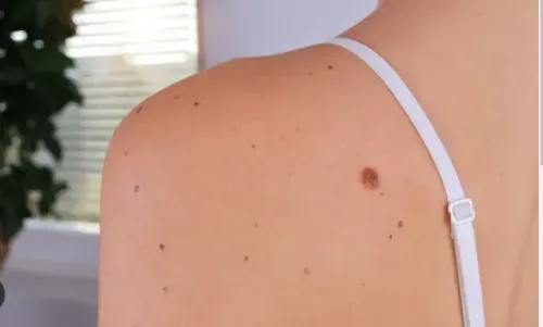 Mole/Wart/Tag Removal service image