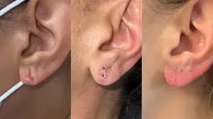 Ear Lobe Repair service image