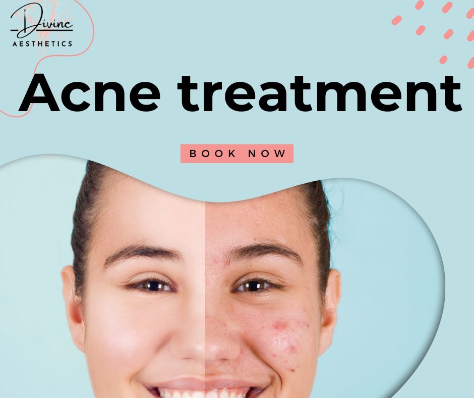 Acne treat