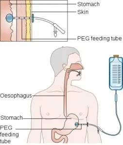 Percutaneous Endoscopic Gastrostomy (PEG) Tube service image