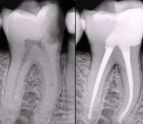 Root Canal Treatment service image