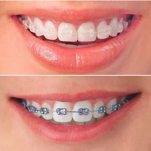 Orthodontic Braces service image
