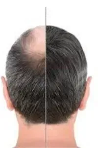 Hair Transplant - Scalp (FUE) service image