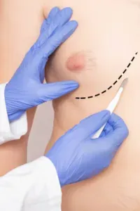 Gynecomastia - Plastic surgery for men service image