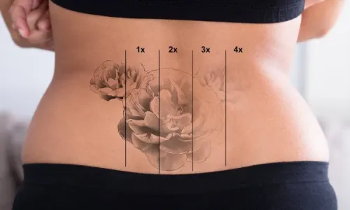 TATTOO REMOVAL service image