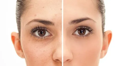 Fractional Co2 Laser service image