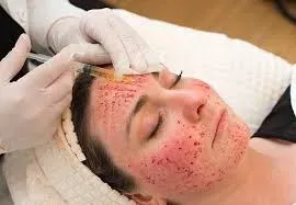 Vampire Facial service image