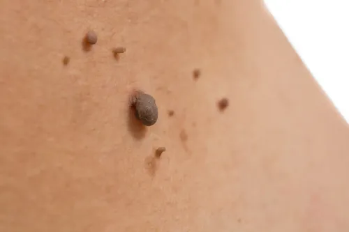 Mole / Skin Tag Removal service image