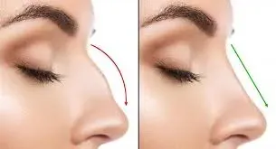 Nose Enhancement service image