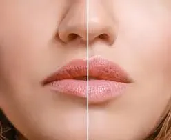 Lip Enhancement service image