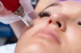 Microneedling service image