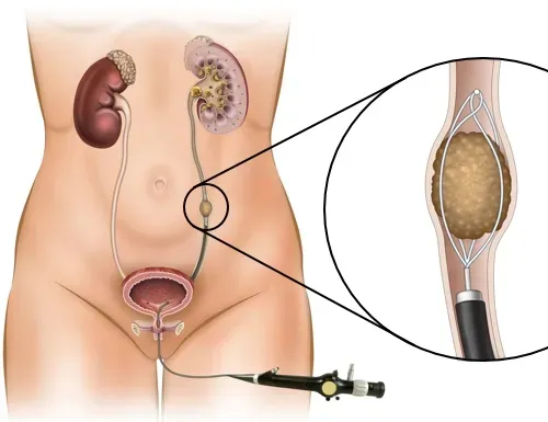 Ureteroscopy for Ureteric Stones service image