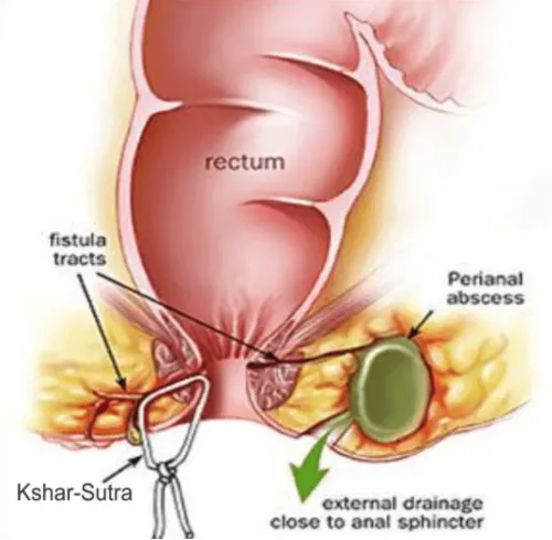 Ksharsutra Treatment for Fistula service image