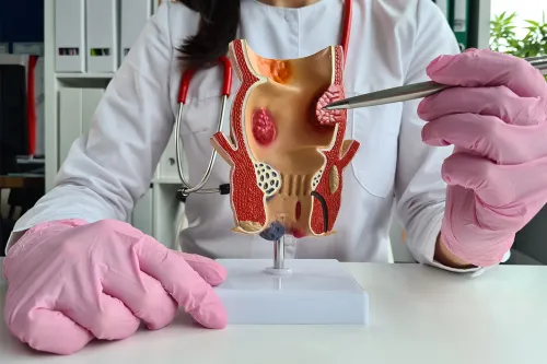 Hemorrhoidectomy (Surgery for Piles) service image