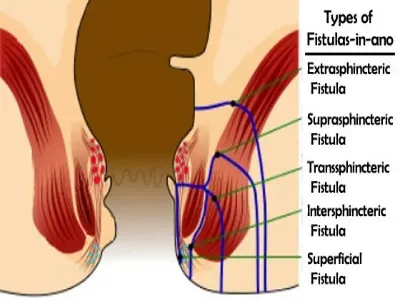 Laser Ablation of Fistula service image