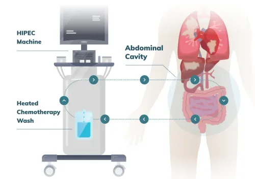 ROBOTIC CYTOREDUCTIVE SURGERY AND HIPEC service image