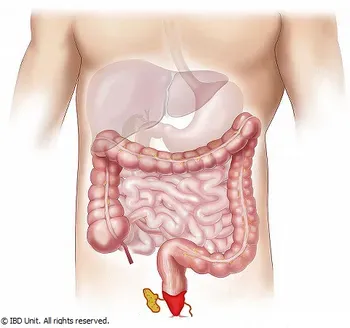 LARGE INTESTINE AND PERIANAL DISEASES service image