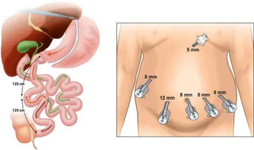 ROBOT ADSISTED SURGERY FOR STOMACHS AND DUODENUM service image