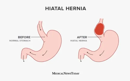 Fundoplication (Hiatus Hernia) service image