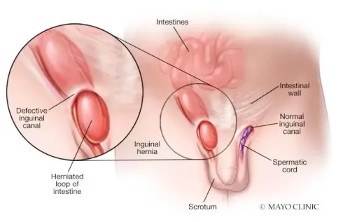 Inguinal Hernia service image